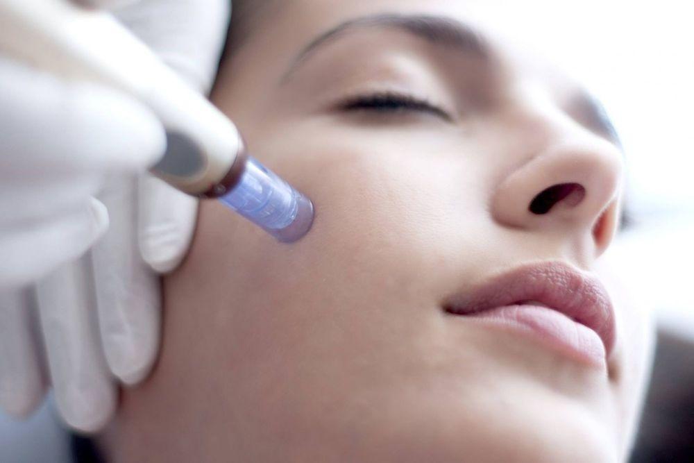 Miss Skin - DermaPen - Microneedling - Μεσοθεραπεία