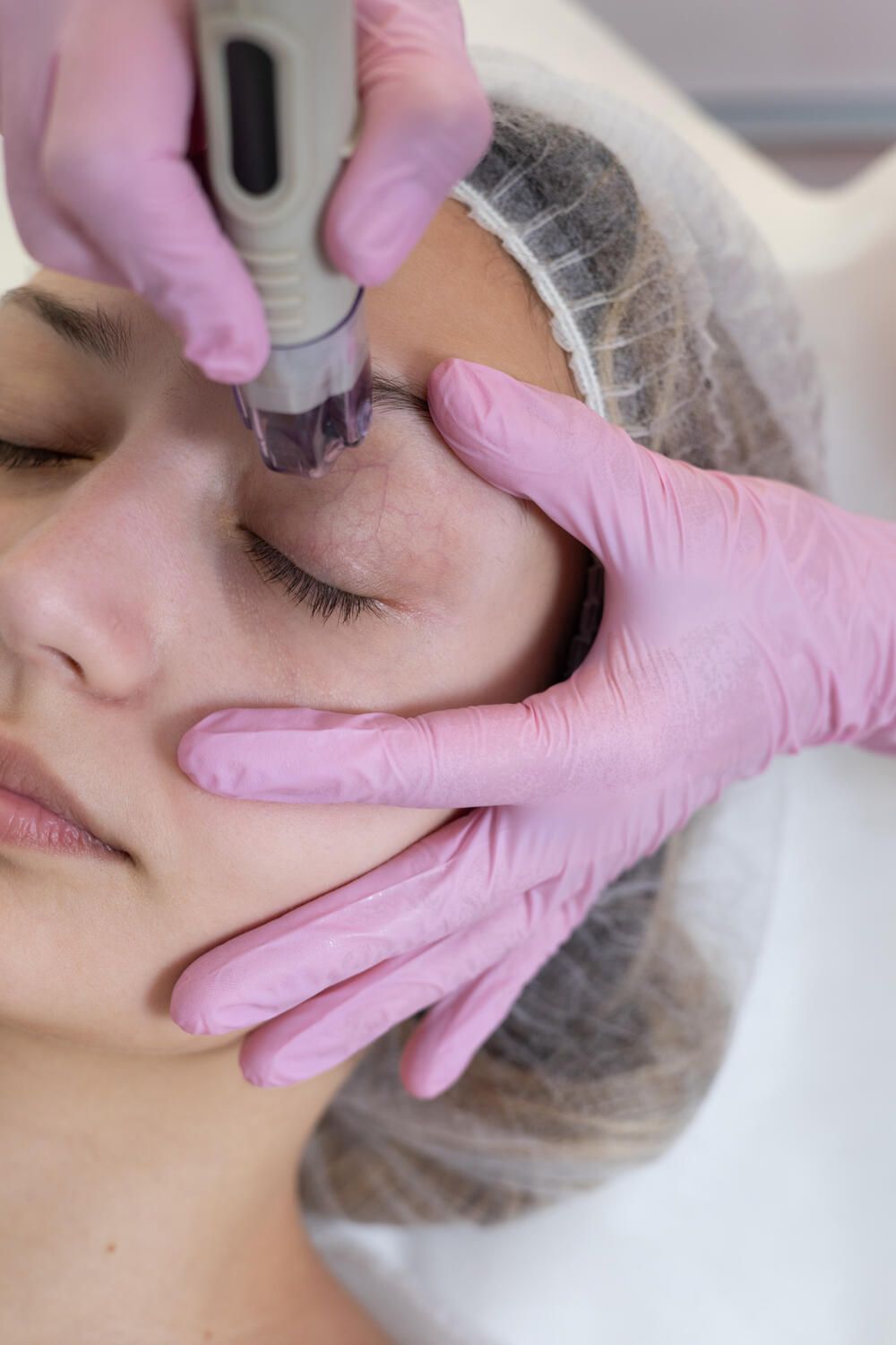 Μεσοθεραπεία Dermafrac αποκλειστικά από την Κόλντηρη Ελπίδα: BSc, MSc Αισθητικός - Κοσμητολόγος